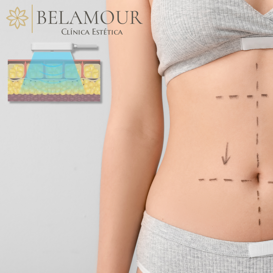 2 Sesiones Criolipólisis Plana + EMS Abdomen Alto + Bajo + Flancos + PSE