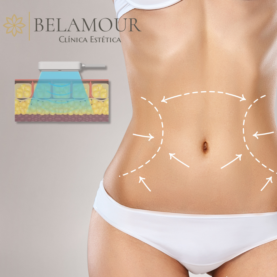 1 Sesión Criolipólisis Plana + EMS Abdomen Alto - Bajo + Flancos y PSE