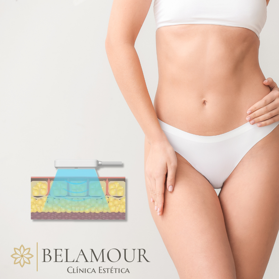1 Sesión Criolipólisis Plana + EMS Abdomen Alto y Bajo