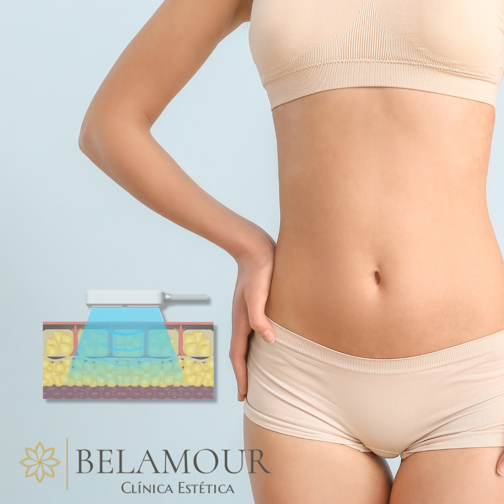 1 Sesión Criolipólisis Plana + EMS Abdomen Alto - Bajo + Flancos